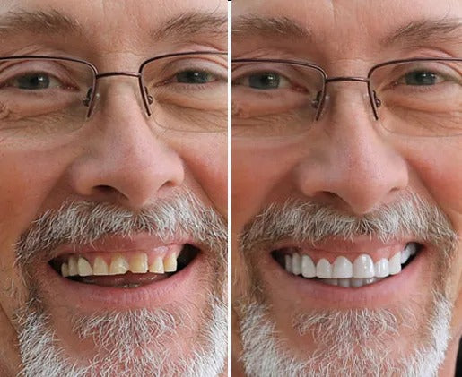 LumiLid™ Snap-On Veneers