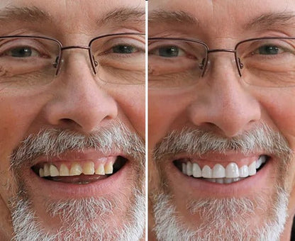 LumiLid™ Snap-On Veneers