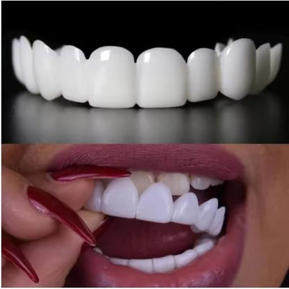 LumiLid™ Snap-On Veneers